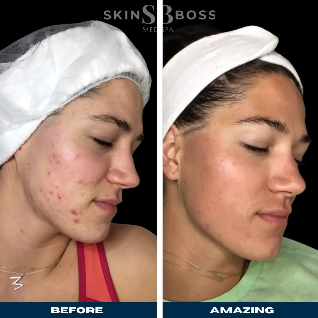 Acne Boss Bootcamp Skin Boss Acne Treatment | Haslett, MI
