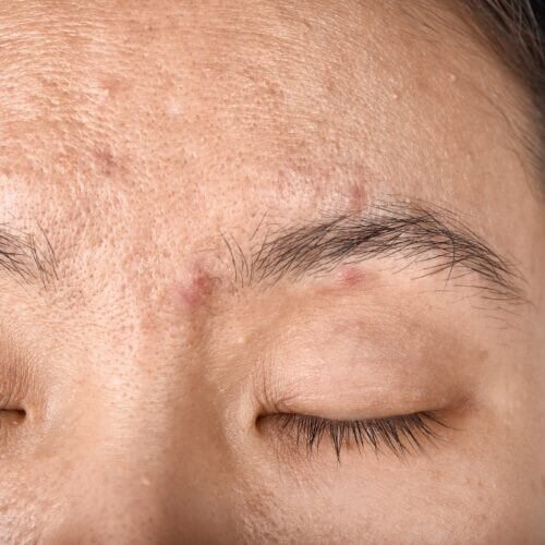 Facial skin problem, Aging problem in adult, wrinkle, acne scar, large pore and dark spot, Dehydrate skin.