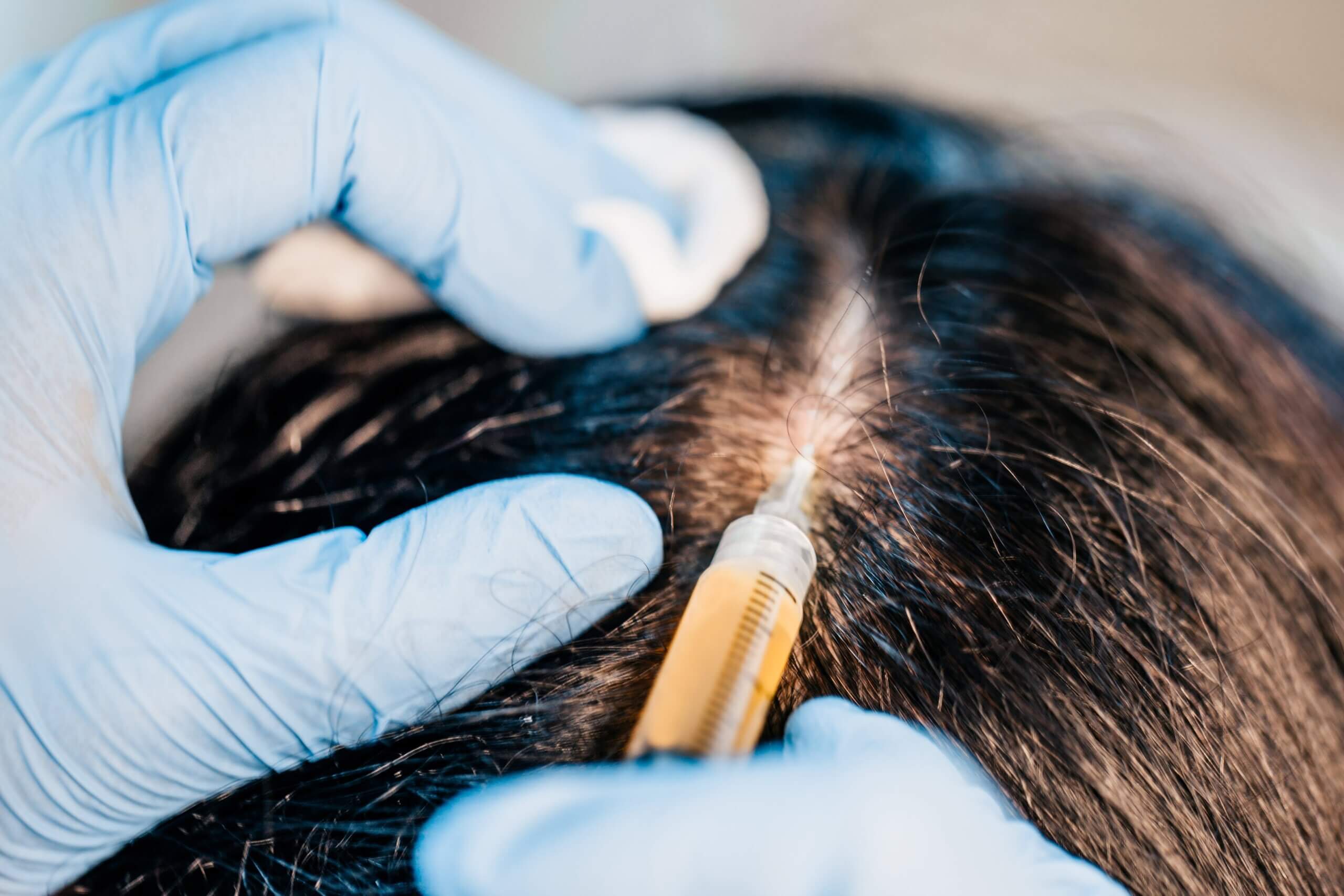 PRP Hair Restoration Skin Boss Med Spa