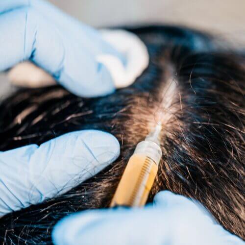 Injection of the drug into the scalp under the scalp - strengthening hair and preventing their loss - selective focus