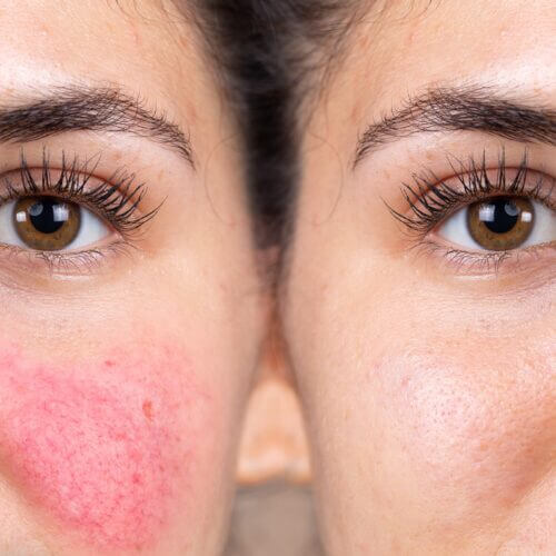 Before and after successful rosacea treatment on the face of a c