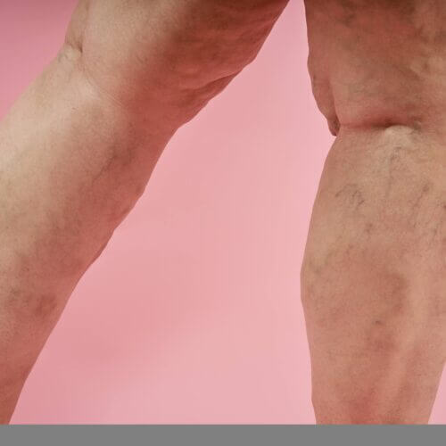 Two legs of senior woman with varicose veins on coral background.